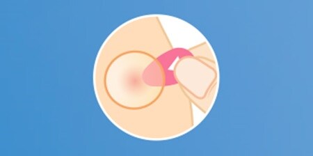 PASSO 2 - Applica con l'applicatore rosso il cerotto per i brufoli sulla pelle
